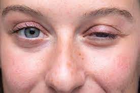 Göz kapağında düşme, çift görme, çiğneme ve yutma zorluğu miyastenia gravis hastalığının habercisi olabilir