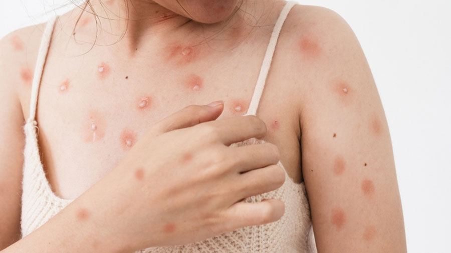 1980 Öncesinde Çiçek Aşısı Olanlar Maymun Çiçeğinden Korunuyor